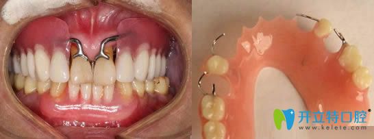 桂洪萍科普活動義齒修復的優(yōu)缺點