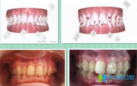 瑾帆口腔深覆合隱形矯正案例前后效果對(duì)比圖