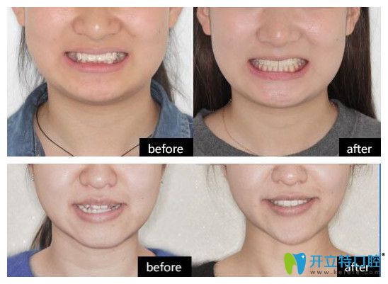 維樂口腔的正畸案例前后效果對比圖