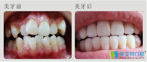 福州維樂口腔牙齒擁擠矯正圖