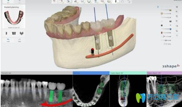 3d導(dǎo)板數(shù)字化種植牙過程圖解