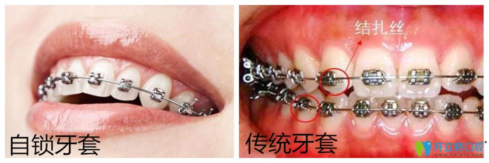 自鎖托槽牙齒矯正多少錢？正畸國產與進口自鎖有區(qū)別嗎?