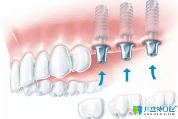 維樂(lè)口腔種植體和牙冠的銜接圖