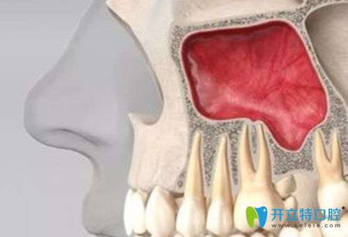種植牙時做上頜竇提升有沒有危險
