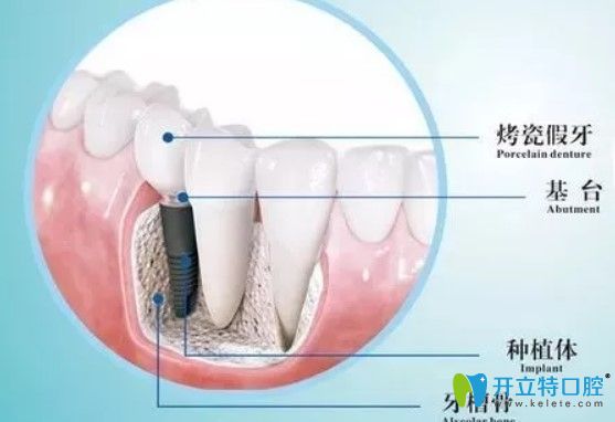 維樂(lè)口腔種植牙是由基臺(tái)、種植體組成圖示
