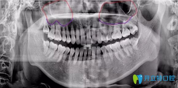 什么是上頜竇內(nèi)外提升術(shù)