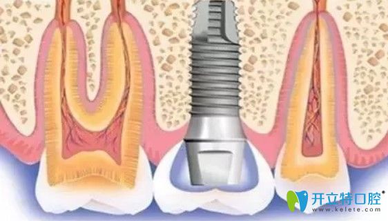 北京維樂(lè)口腔種植體圖示