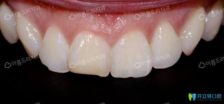 韓國安特麗做牙貼面前牙齒情況