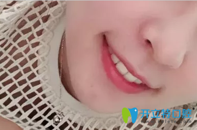 牙齒矯正可以做兩次，正畸效果是美好的