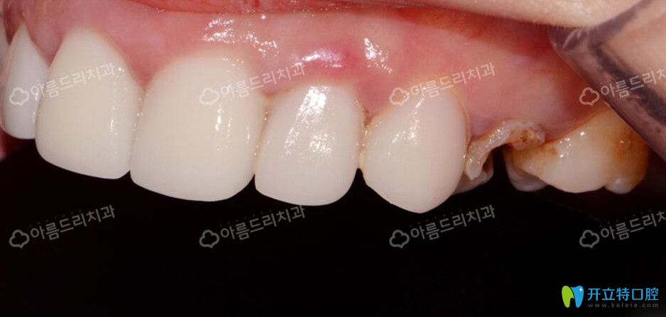 去韓國安特麗做后牙種植前