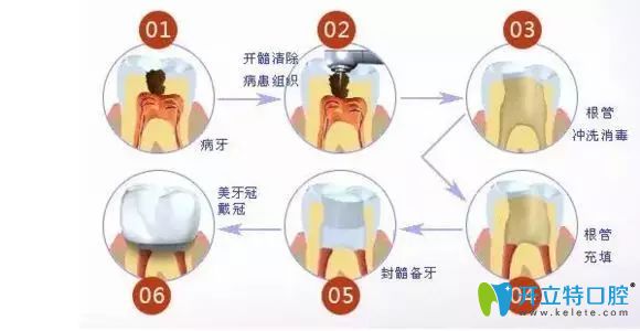 南昌輝煌口腔彭凡主任科普牙齒根管治療注意事項(xiàng)