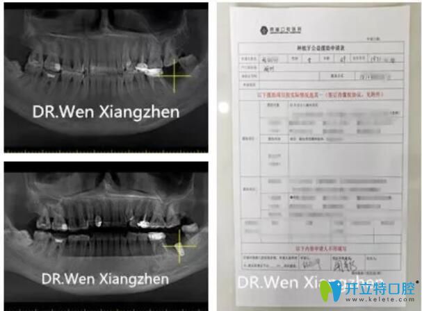 鼎植口腔種植牙案例前后對(duì)比圖