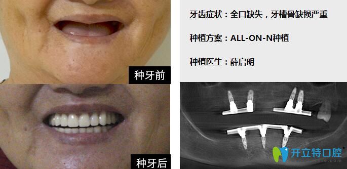 廣州柏德口腔牙醫(yī)薛啟明全口種植牙案例
