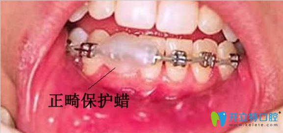 使用正畸蠟的注意事項(xiàng)介紹