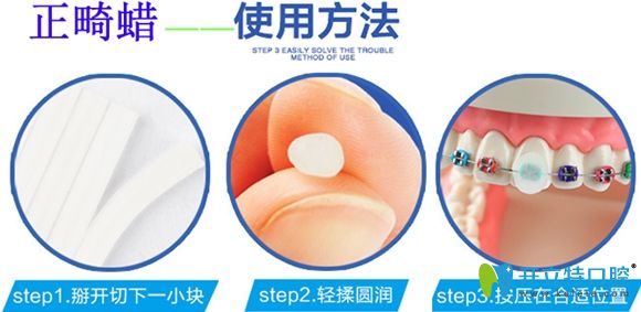 正畸保護(hù)蠟的使用方法圖解