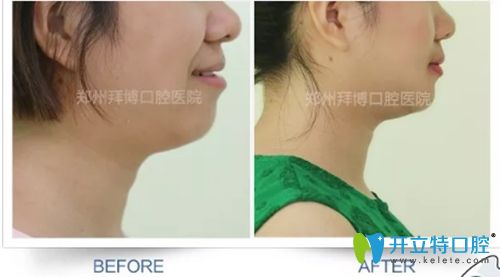 鄭州拜博口腔大齡矯正案例圖