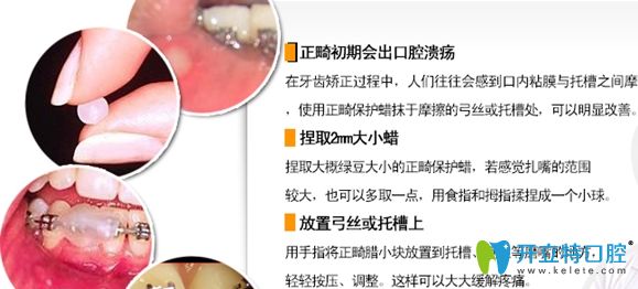 牙套托槽磨嘴怎么辦，可使用正畸蠟來保護(hù)口腔粘膜