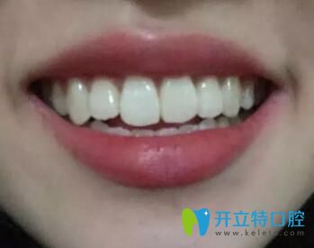 我在西安中諾口腔做牙齒矯正1年3個月