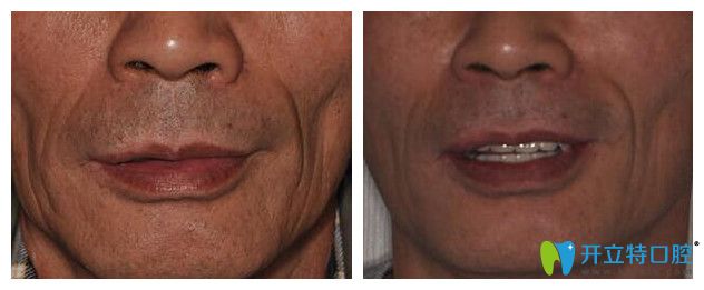 <!--<i data=20240703-sp></i>-->口腔全口種植牙<span style=