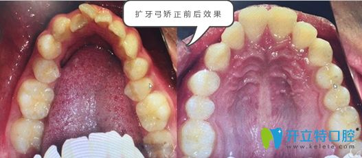 擴(kuò)弓矯正的前后效果對比圖