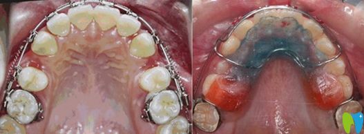 牙齒矯正擴(kuò)牙弓和拔牙對比圖