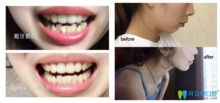 清華陽光口腔下頜牙列擁擠矯正案例圖