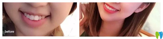 清華陽光齙牙矯正案例圖