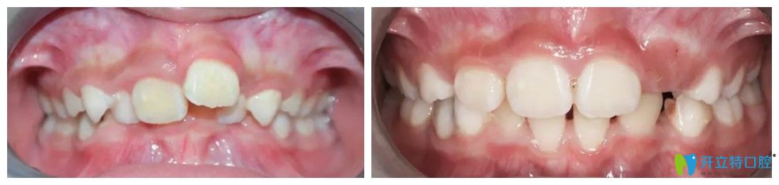 超龍牙博士口腔兒童深覆合矯正案例圖