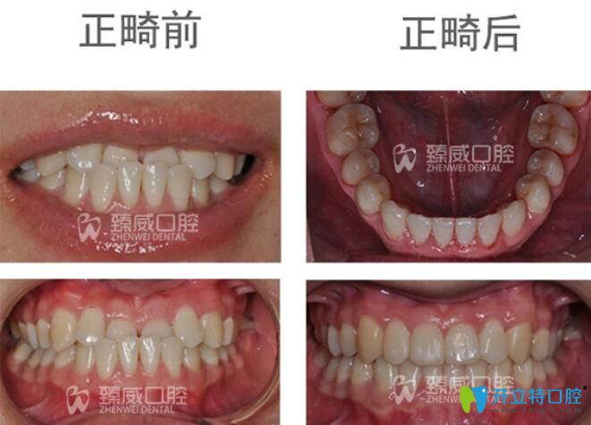 小姐姐矯正地包天后不僅牙齒變整齊了，臉型也有了很大的改變