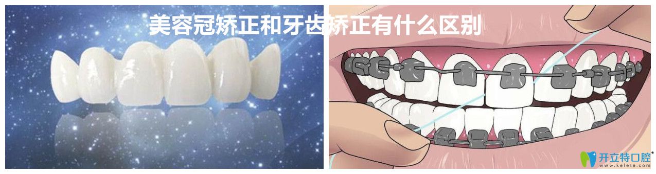 美容冠和牙齒矯正有什么區(qū)別