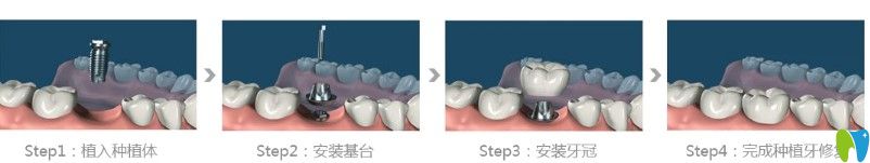 維嘉口腔種植牙過程圖示