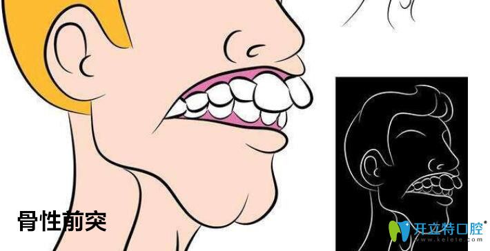 美容冠矯正齙牙效果如何