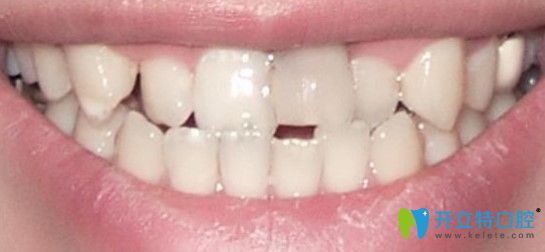 牙齒沒做矯正之前圖示 牙齒沒做矯正之前圖示