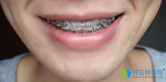 牙齒矯正一年三個(gè)月后的樣子圖 牙齒矯正一年三個(gè)月后的樣子圖