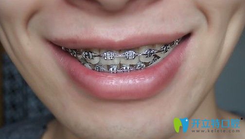 矯正5個(gè)月后的效果圖 矯正5個(gè)月后的效果圖