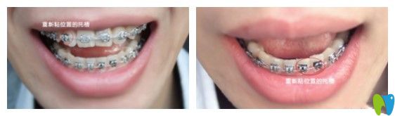 第七次復(fù)診牙齒的樣子 第七次復(fù)診牙齒的樣子