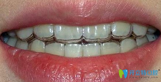 隱形透明牙套效果圖