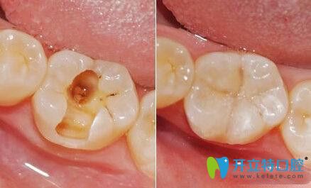 樹脂補(bǔ)牙材料