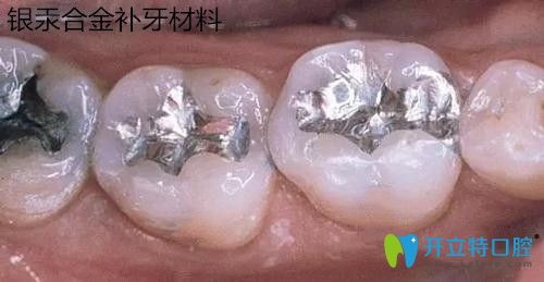 銀汞合金補(bǔ)牙材料