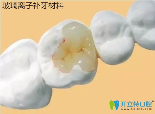 玻璃離子補(bǔ)牙材料