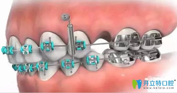 暑假做牙齒矯正有足夠的適應(yīng)時間
