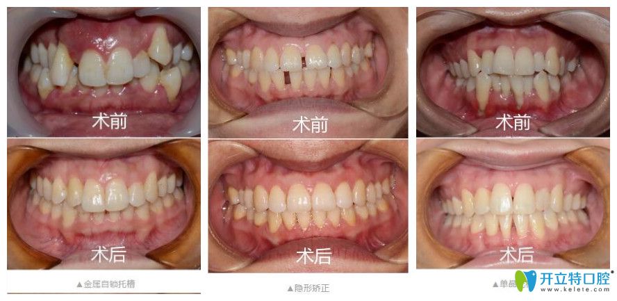 寧波恒美口腔做矯正怎么樣？矯正價格不貴技術(shù)好