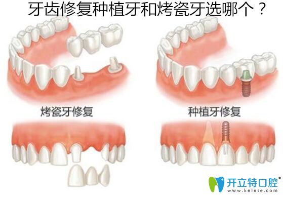 18歲缺失牙齒修復(fù)種植牙和烤瓷牙選哪個(gè)？