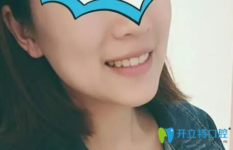 我在北京中諾口腔做牙齒矯正15個(gè)月