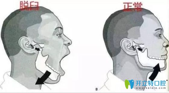 下巴錯(cuò)位與正常對(duì)照?qǐng)D