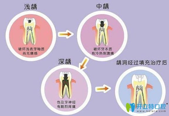 齲齒的發(fā)展過程圖示