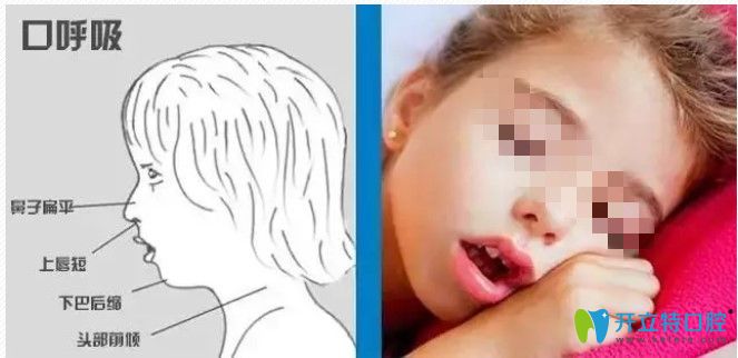 長(zhǎng)期口呼吸對(duì)面部的影響圖示