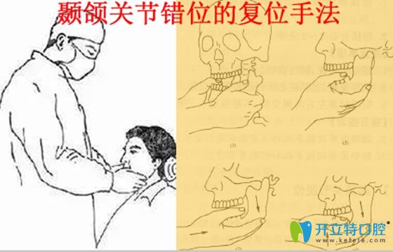 顳頜關(guān)節(jié)錯(cuò)位的復(fù)位治療手法圖
