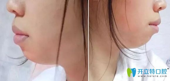 我的齙牙引起突嘴的側(cè)面照 我的齙牙引起突嘴的側(cè)面照