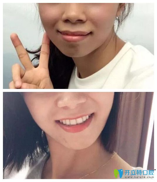 小齙牙矯正前后正面臉型對比圖 小齙牙矯正前后正面臉型對比圖